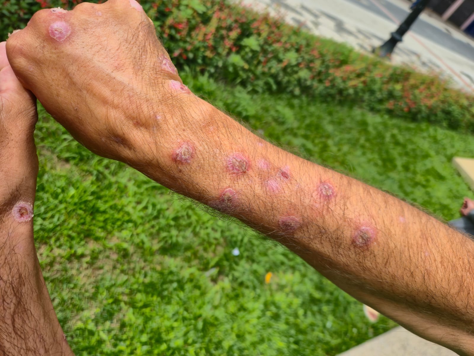 Moradores de unidades de acolhimento de Curitiba denunciam infestação de percevejos