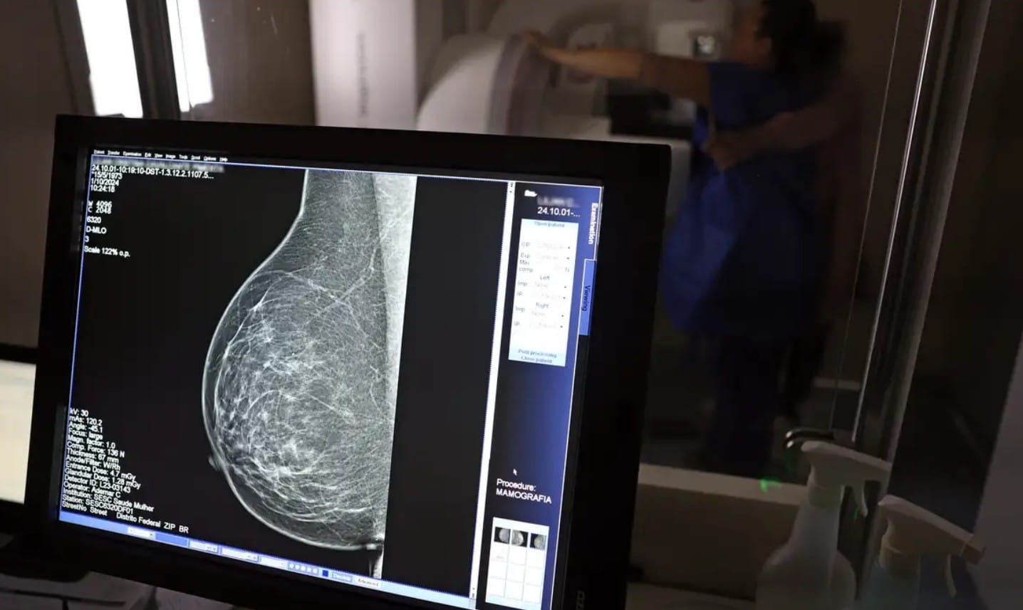 Projeto prevê distribuição de sutiãs para mulheres que passaram por mastectomia